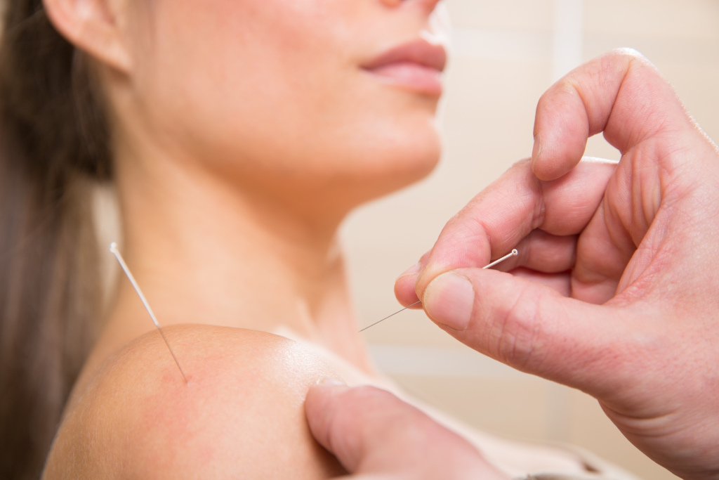 General acupuncture services for shoulder pain.