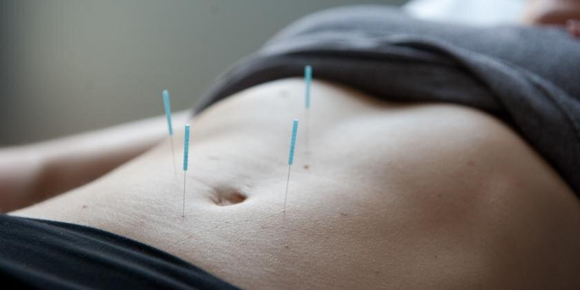 Closeup of woman's tummy during preventive health acupuncture tuneup.